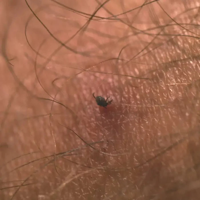 Tick head buried in to human skin showing the body and legs left outside