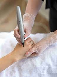CryoPen Treatment