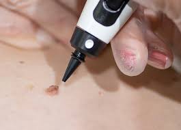 CryoPen Treatment