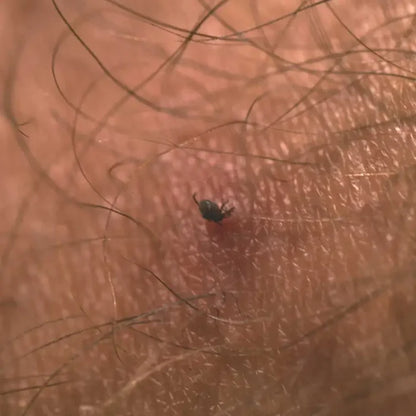 Tick head buried in to human skin showing the body and legs left outside